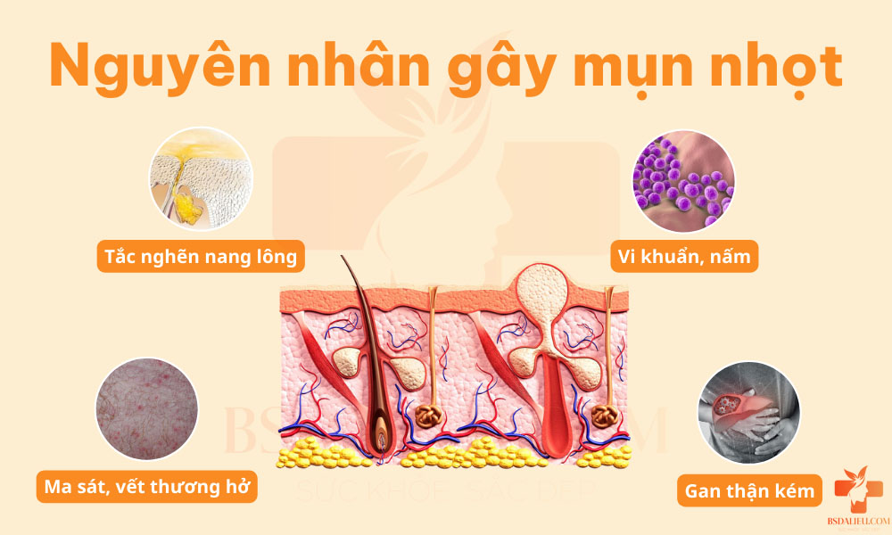 4 nguyên nhân chính gây mụn nhọt trên da