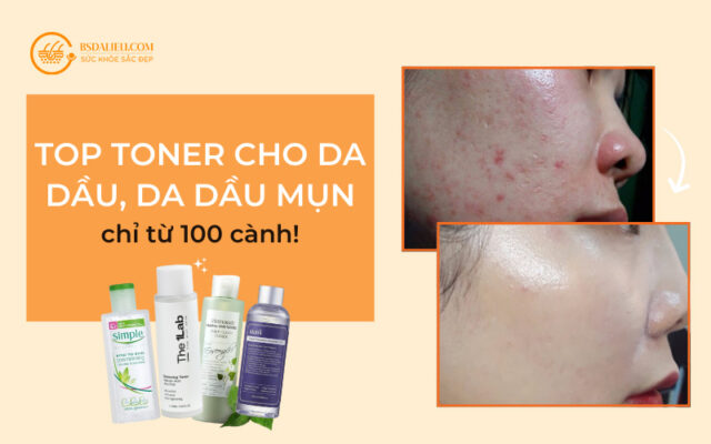 Toner cho da dầu mụn